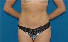 Liposuction After Photo by Scott Sattler, MD,  FACS; Seattle, WA - Case 46397