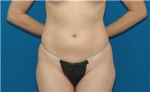 Liposuction Before Photo by Scott Sattler, MD,  FACS; Seattle, WA - Case 46397