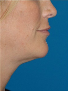 Liposuction After Photo by Scott Sattler, MD,  FACS; Seattle, WA - Case 46398