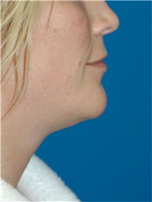 Liposuction Before Photo by Scott Sattler, MD,  FACS; Seattle, WA - Case 46398