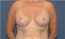 Breast Reduction After Photo by Scott Sattler, MD,  FACS; Seattle, WA - Case 46399