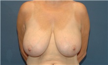 Breast Reduction Before Photo by Scott Sattler, MD,  FACS; Seattle, WA - Case 46399