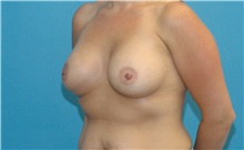 Breast Augmentation After Photo by Scott Sattler, MD,  FACS; Seattle, WA - Case 46400