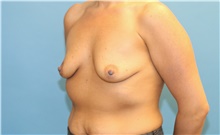 Breast Augmentation Before Photo by Scott Sattler, MD,  FACS; Seattle, WA - Case 46400