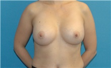 Breast Augmentation After Photo by Scott Sattler, MD,  FACS; Seattle, WA - Case 46401