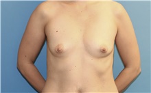Breast Augmentation Before Photo by Scott Sattler, MD,  FACS; Seattle, WA - Case 46401