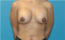 Breast Augmentation After Photo by Scott Sattler, MD,  FACS; Seattle, WA - Case 46402