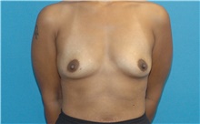 Breast Augmentation Before Photo by Scott Sattler, MD,  FACS; Seattle, WA - Case 46402