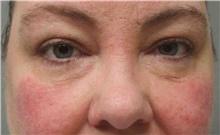 Eyelid Surgery After Photo by Scott Sattler, MD,  FACS; Seattle, WA - Case 46408