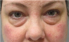 Eyelid Surgery Before Photo by Scott Sattler, MD,  FACS; Seattle, WA - Case 46408