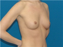 Breast Augmentation Before Photo by Scott Sattler, MD,  FACS; Seattle, WA - Case 46409