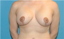 Breast Lift After Photo by Scott Sattler, MD,  FACS; Seattle, WA - Case 46410