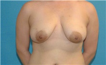 Breast Lift Before Photo by Scott Sattler, MD,  FACS; Seattle, WA - Case 46410