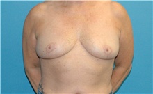 Breast Implant Removal After Photo by Scott Sattler, MD,  FACS; Seattle, WA - Case 46411