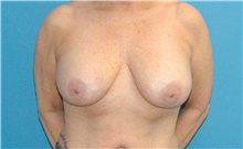 Breast Implant Removal Before Photo by Scott Sattler, MD,  FACS; Seattle, WA - Case 46411
