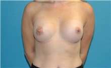 Breast Augmentation After Photo by Scott Sattler, MD,  FACS; Seattle, WA - Case 46416