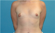 Breast Augmentation Before Photo by Scott Sattler, MD,  FACS; Seattle, WA - Case 46416