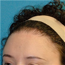 Hair Transplant After Photo by Scott Sattler, MD,  FACS; Seattle, WA - Case 46424