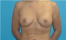 Breast Augmentation After Photo by Scott Sattler, MD,  FACS; Seattle, WA - Case 46429