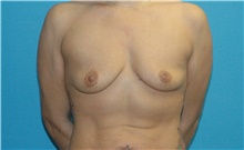 Breast Augmentation Before Photo by Scott Sattler, MD,  FACS; Seattle, WA - Case 46429
