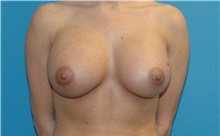 Breast Augmentation After Photo by Scott Sattler, MD,  FACS; Seattle, WA - Case 46430