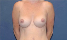 Breast Augmentation After Photo by Scott Sattler, MD,  FACS; Seattle, WA - Case 46501