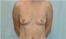 Breast Augmentation Before Photo by Scott Sattler, MD,  FACS; Seattle, WA - Case 46501