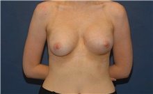 Breast Augmentation After Photo by Scott Sattler, MD,  FACS; Seattle, WA - Case 46502