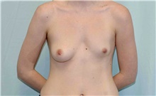 Breast Augmentation Before Photo by Scott Sattler, MD,  FACS; Seattle, WA - Case 46502