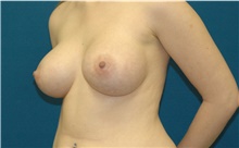 Breast Augmentation After Photo by Scott Sattler, MD,  FACS; Seattle, WA - Case 46503
