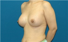 Breast Augmentation After Photo by Scott Sattler, MD,  FACS; Seattle, WA - Case 46505