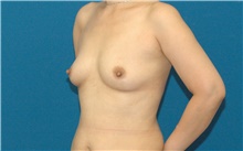Breast Augmentation Before Photo by Scott Sattler, MD,  FACS; Seattle, WA - Case 46505