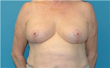 Breast Reduction After Photo by Scott Sattler, MD,  FACS; Seattle, WA - Case 46506