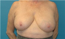 Breast Reduction Before Photo by Scott Sattler, MD,  FACS; Seattle, WA - Case 46506