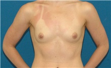 Breast Augmentation Before Photo by Scott Sattler, MD,  FACS; Seattle, WA - Case 46507