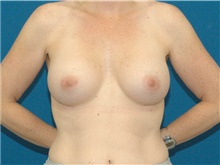 Breast Augmentation After Photo by Scott Sattler, MD,  FACS; Seattle, WA - Case 46509