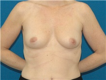 Breast Augmentation Before Photo by Scott Sattler, MD,  FACS; Seattle, WA - Case 46509