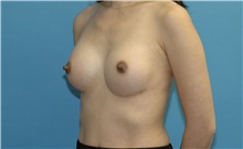 Breast Augmentation After Photo by Scott Sattler, MD,  FACS; Seattle, WA - Case 46511