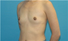 Breast Augmentation Before Photo by Scott Sattler, MD,  FACS; Seattle, WA - Case 46511