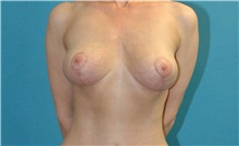 Breast Lift After Photo by Scott Sattler, MD,  FACS; Seattle, WA - Case 46524