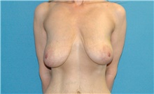 Breast Lift Before Photo by Scott Sattler, MD,  FACS; Seattle, WA - Case 46524