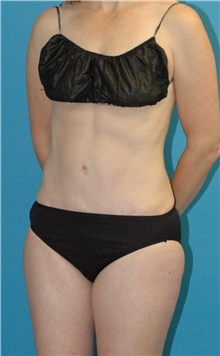 Tummy Tuck After Photo by Scott Sattler, MD,  FACS; Seattle, WA - Case 46532
