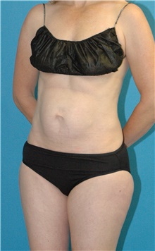 Tummy Tuck Before Photo by Scott Sattler, MD,  FACS; Seattle, WA - Case 46532