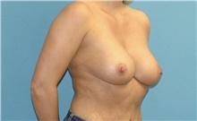 Breast Implant Revision After Photo by Scott Sattler, MD,  FACS; Seattle, WA - Case 46579