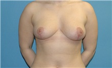 Breast Reduction After Photo by Scott Sattler, MD,  FACS; Seattle, WA - Case 46991