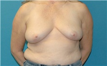 Breast Implant Removal After Photo by Scott Sattler, MD,  FACS; Seattle, WA - Case 47057