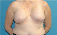 Breast Implant Removal Before Photo by Scott Sattler, MD,  FACS; Seattle, WA - Case 47057