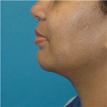 Chin Augmentation After Photo by Scott Sattler, MD,  FACS; Seattle, WA - Case 47086