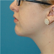 Chin Augmentation After Photo by Scott Sattler, MD,  FACS; Seattle, WA - Case 47087