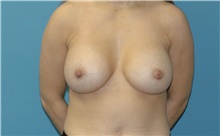 Breast Augmentation After Photo by Scott Sattler, MD,  FACS; Seattle, WA - Case 47091